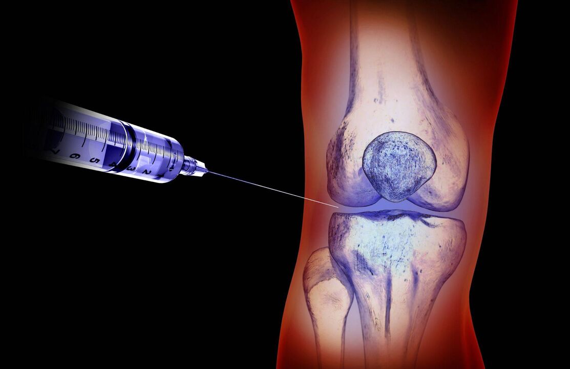 intra-articular injections for arthritis