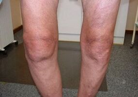 How to treat arthritis in knee joints