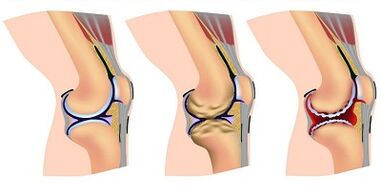 Development in joints in joints knee