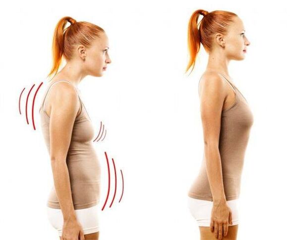 correct and incorrect posture as a cause of pleurisy