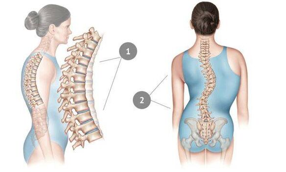 flexibility of the spine as a cause of osteoporosis in the chest