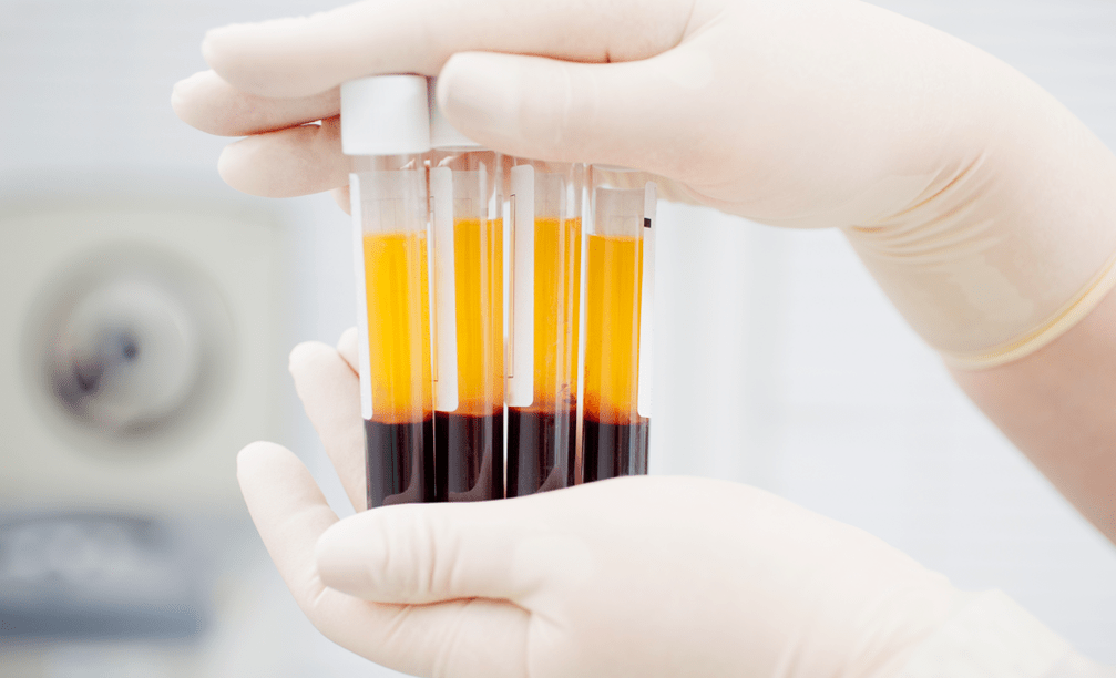 Platelet-rich plasma for PRP therapy in arthritis