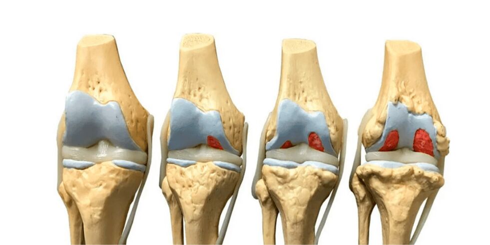 stage of arthritis in the joints